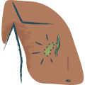 Gallbladder Removal
