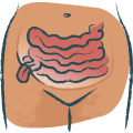 Inguinal Hernias
