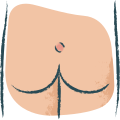 Pilonidal Cyst